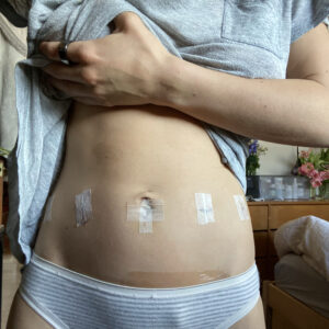 image of a light skinned person's belly with surgery scars from endometriosis excision surgery